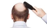 Treatment of Baldness